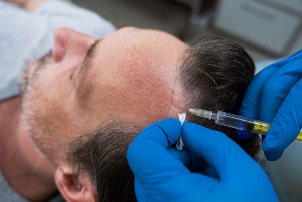 Why Hair Transplant In Turkey Is Becoming So Popular?